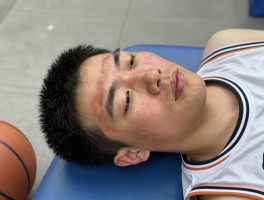 篮球砸脸了应急处理指南，被篮球砸到脸怎么快速消肿,篮球砸脸后头晕怎么办,会留下疤痕吗